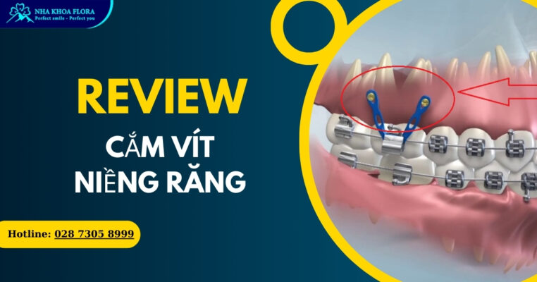 Bắt vít niềng răng