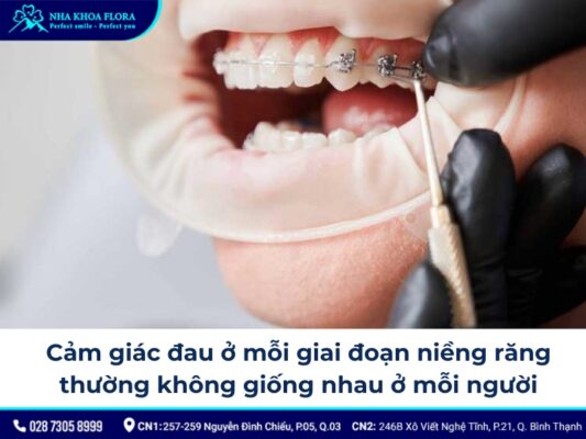 các giai đoạn niềng răng - ảnh 4
