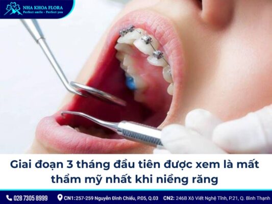 các giai đoạn niềng răng - ảnh 5