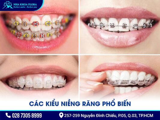 Các kiểu niềng răng - ảnh 1