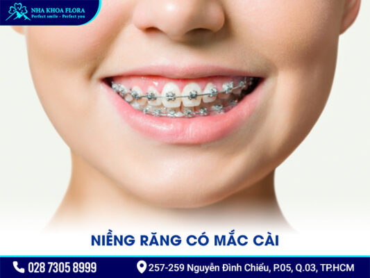 Các kiểu niềng răng - ảnh 2