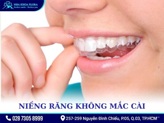 Các kiểu niềng răng - ảnh 3