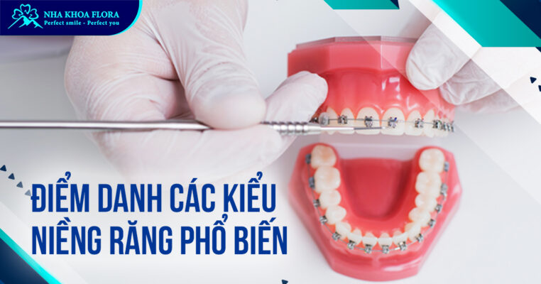 Các kiểu niềng răng