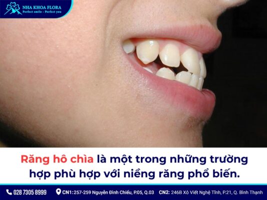Có nên niềng răng không - ảnh 5