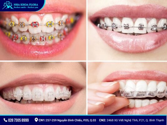 Có nên niềng răng không - ảnh 6