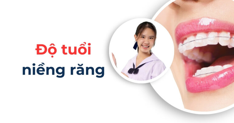 độ tuổi niềng răng