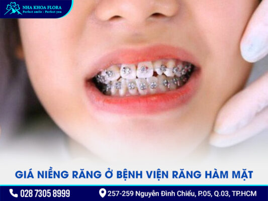 Giá niềng răng ở bệnh viện Răng hàm mặt - ảnh 1