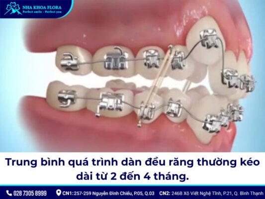 giai đoạn xấu nhất khi niềng răng - ảnh 1 giai đoạn xấu nhất khi niềng răng - ảnh 1