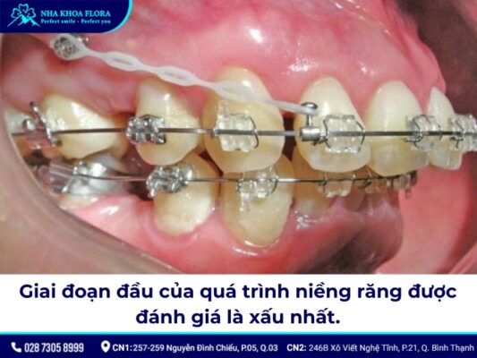 giai đoạn xấu nhất khi niềng răng - ảnh 2 giai đoạn xấu nhất khi niềng răng - ảnh 2