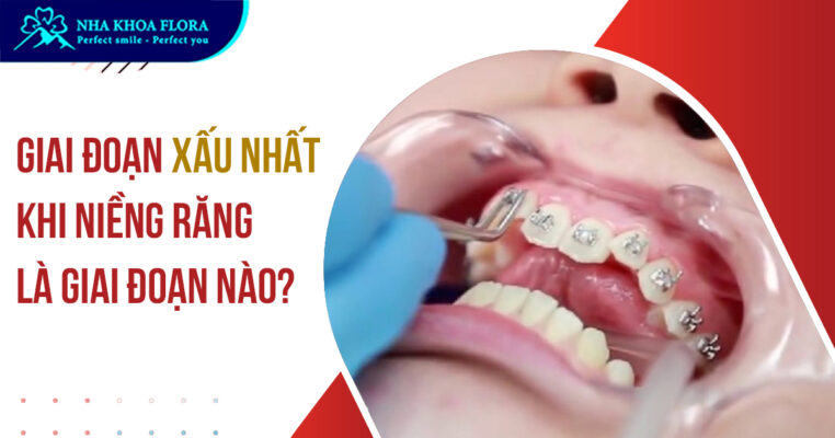 Giai đoạn xấu nhất khi niềng răng
