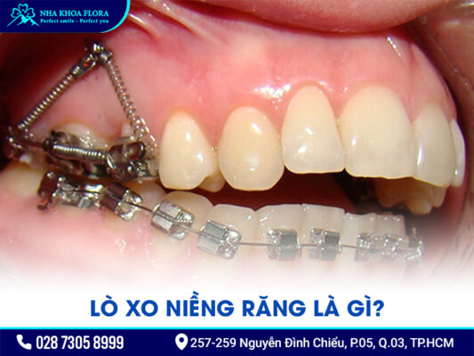 Lò xo niềng răng - ảnh 1