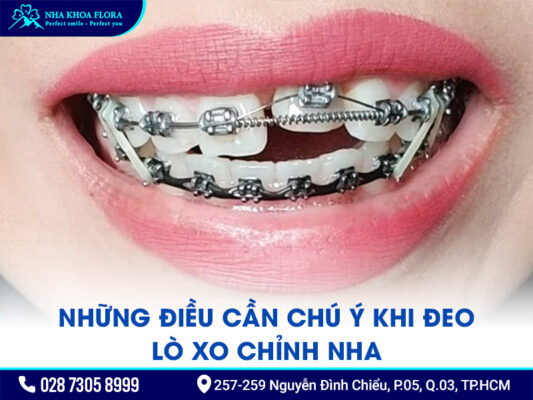 Lò xo niềng răng - ảnh 4