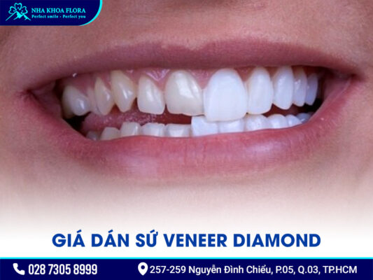 Mặt dán sứ Diamond - ảnh 5