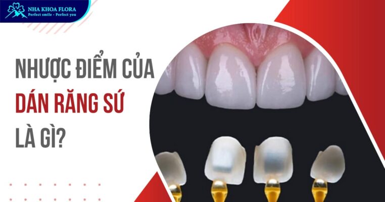 nhược điểm của dán răng sứ