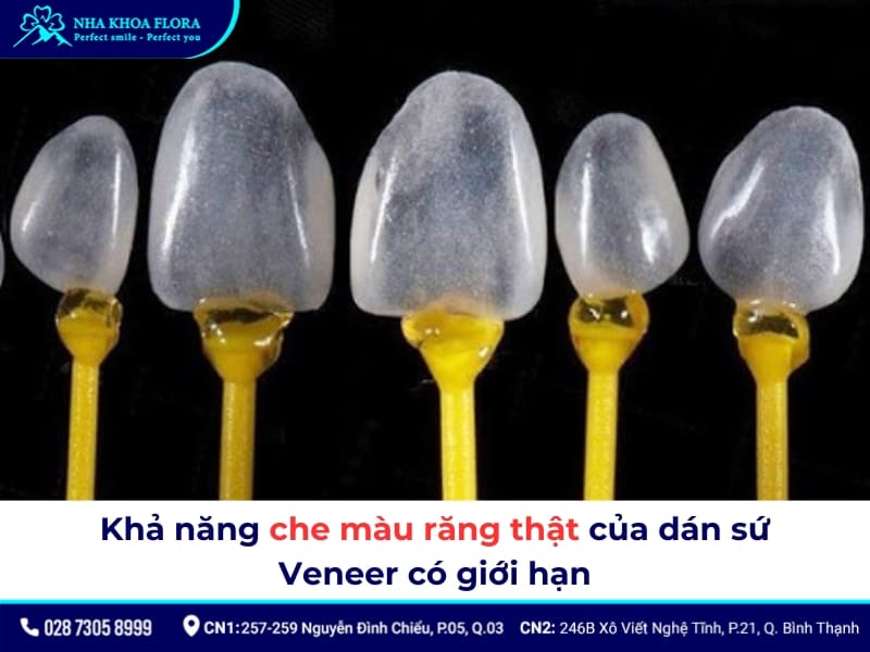 nhược điểm của dán răng sứ