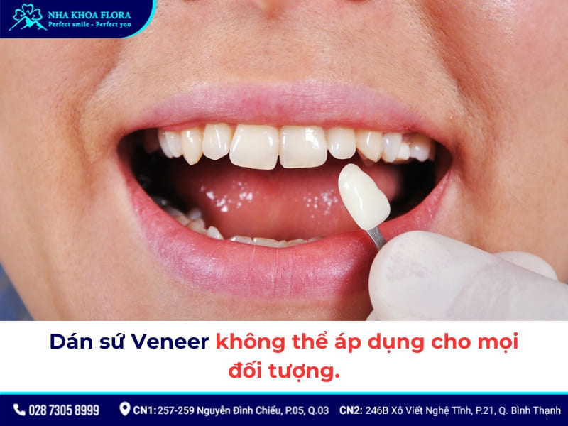 nhược điểm của dán răng sứ