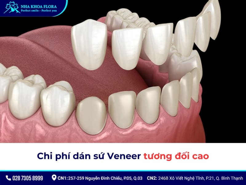 nhược điểm của dán răng sứ
