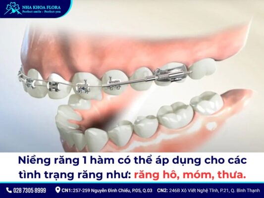 niềng răng 1 hàm - ảnh 2 niềng răng 1 hàm - ảnh 2