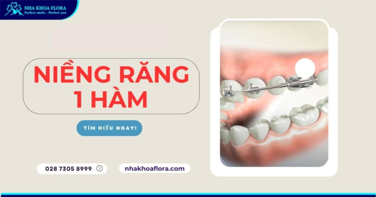 niềng răng 1 hàm