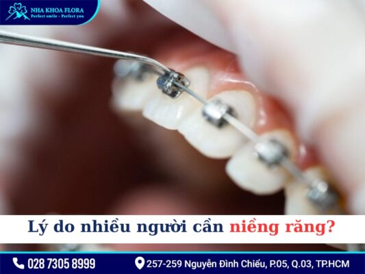 Niềng răng 10 triệu - ảnh 1 Niềng răng 10 triệu - ảnh 1