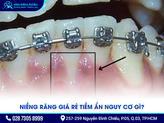 Niềng răng 5 triệu - ảnh 2