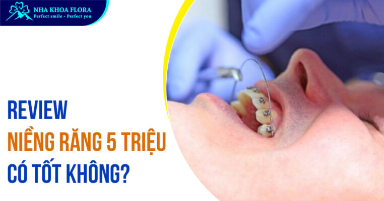 Niềng răng 5 triệu