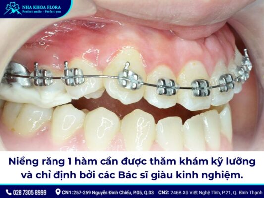 Niềng răng bao nhiêu tiền 1 hàm - ảnh 1
