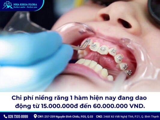 Niềng răng bao nhiêu tiền 1 hàm - ảnh 2