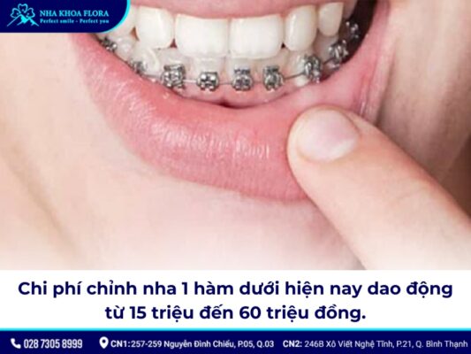 Niềng răng bao nhiêu tiền 1 hàm - ảnh 4