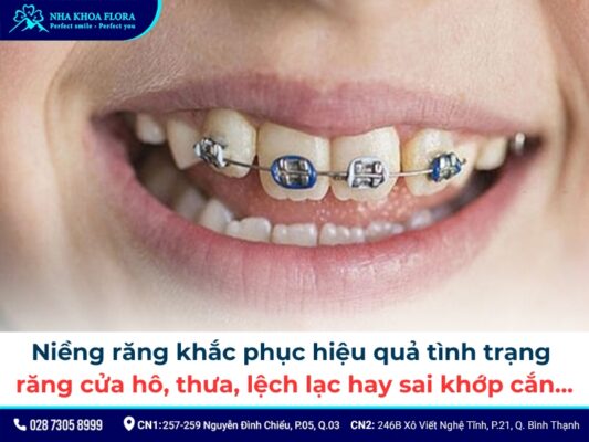 niềng răng cửa - ảnh 1