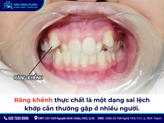 Niềng răng khểnh - ảnh 1