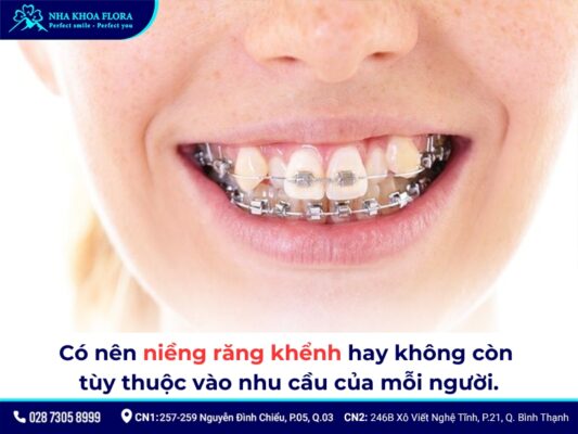 Niềng răng khểnh - ảnh 2
