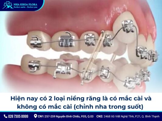 Niềng răng khểnh - ảnh 3