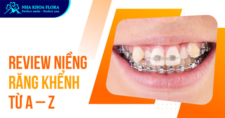 Niềng răng khểnh