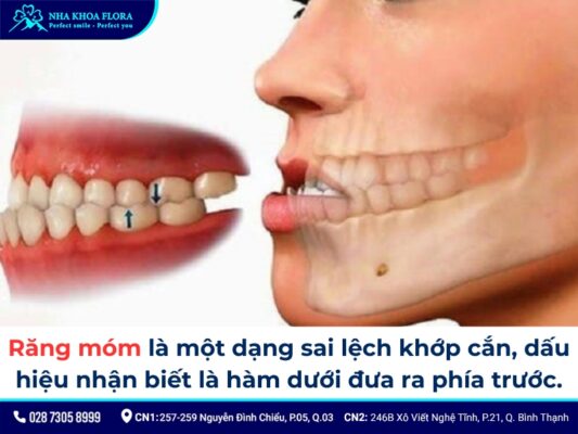 niềng răng móm - ảnh 1