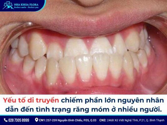 niềng răng móm - ảnh 2