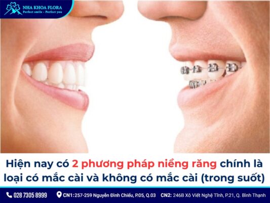 niềng răng móm - ảnh 4