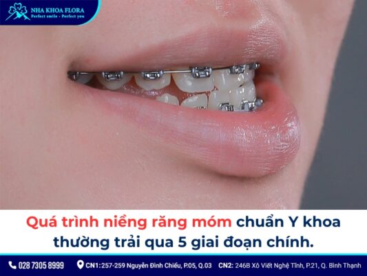 niềng răng móm - ảnh 5
