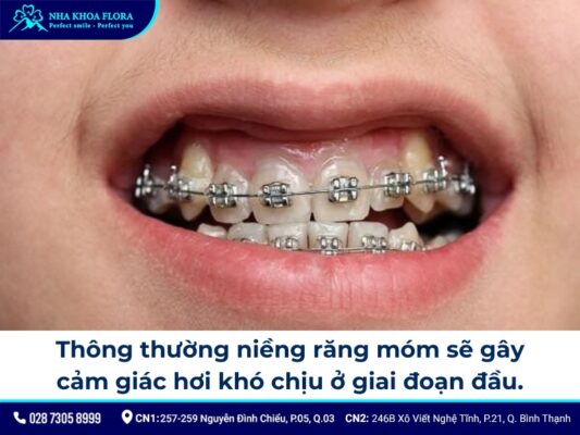 niềng răng móm - ảnh 6