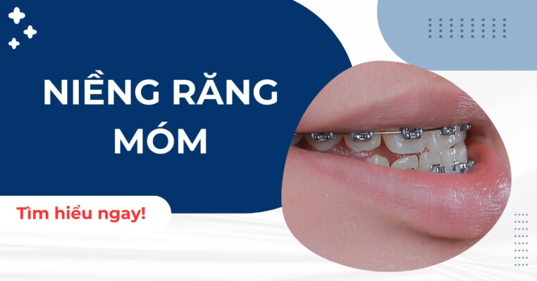 niềng răng móm