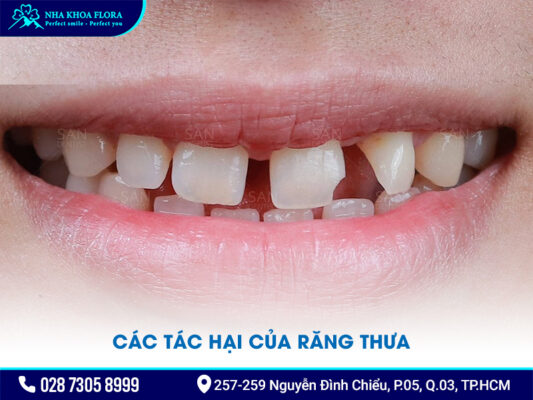 Niềng răng thưa 1 hàm giá bao nhiêu - ảnh 2