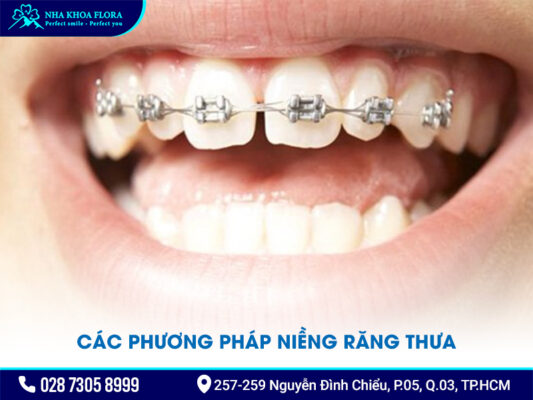 Niềng răng thưa 1 hàm giá bao nhiêu - ảnh 3