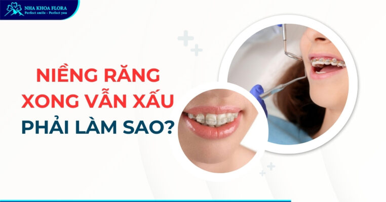 Niềng răng xong vẫn xấu