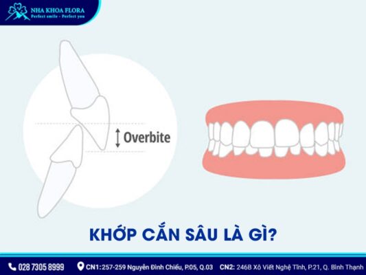 quy trình niềng răng khớp cắn sâu - ảnh 1