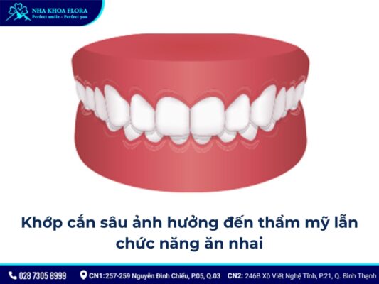 quy trình niềng răng khớp cắn sâu - ảnh 2