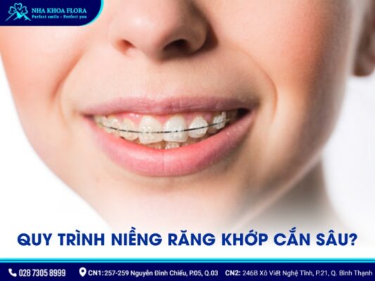 quy trình niềng răng khớp cắn sâu - ảnh 4
