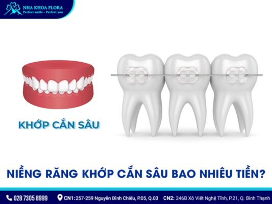quy trình niềng răng khớp cắn sâu - ảnh 6