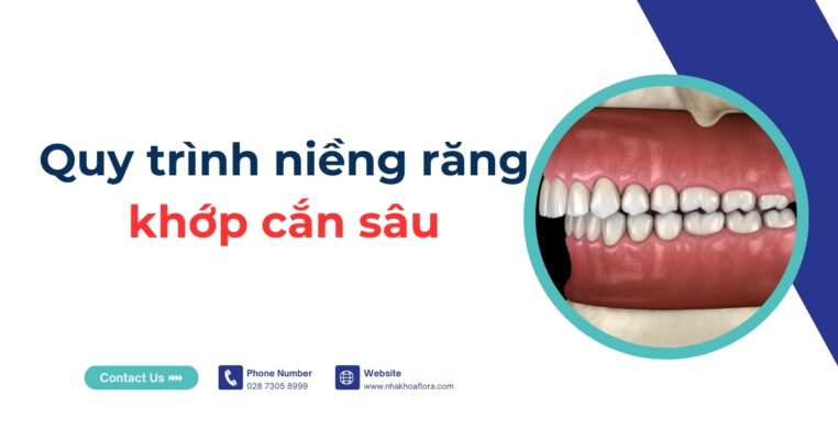 quy trình niềng răng khớp cắn sâu