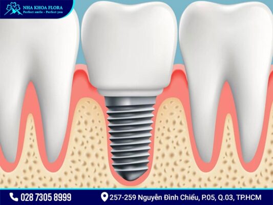 etk implant Pháp - ảnh 3