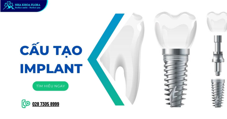 Cấu tạo Implant